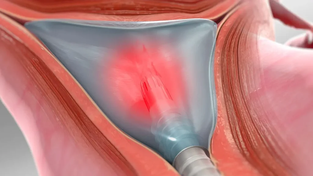 endometrial-ablation-in-dubai