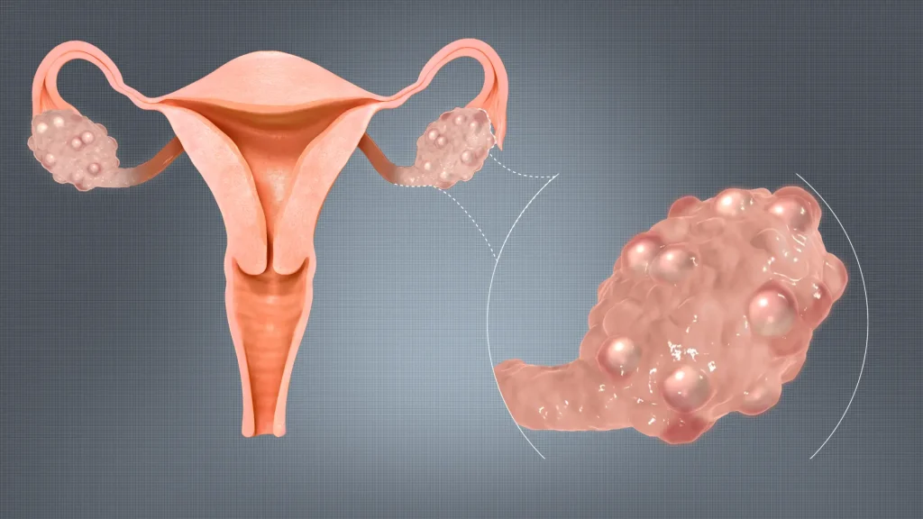 pcos-the-cause-of-irregular-periods