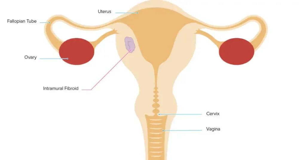 intramural-uterine-fibroids