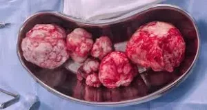 uterine-fibroids