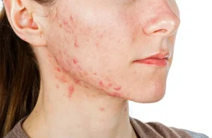 hormonal-acne-in-women