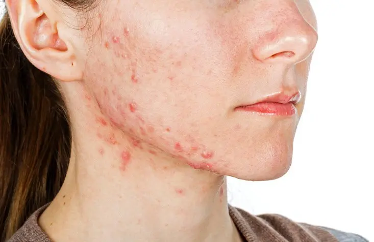 hormonal-acne-in-women
