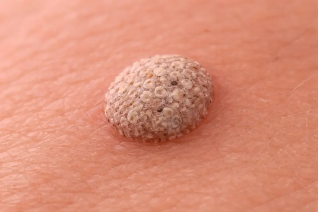 genital-warts-treatment