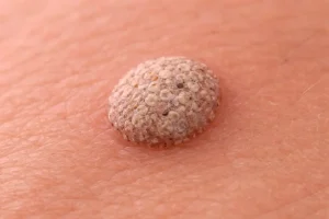 genital-warts-treatment