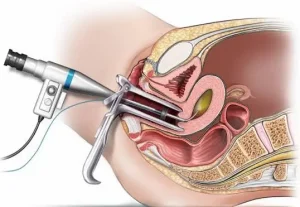 hysteroscopy
