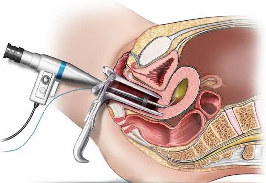 hysteroscopy