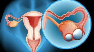 ovarian-torsion