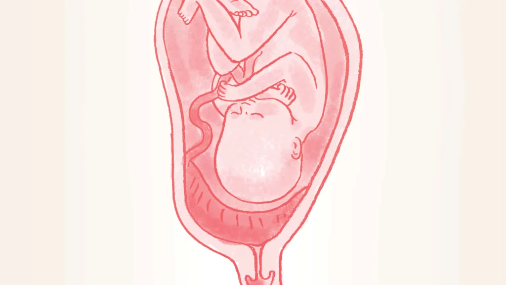 placenta-previa