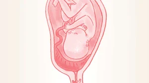 placenta-previa