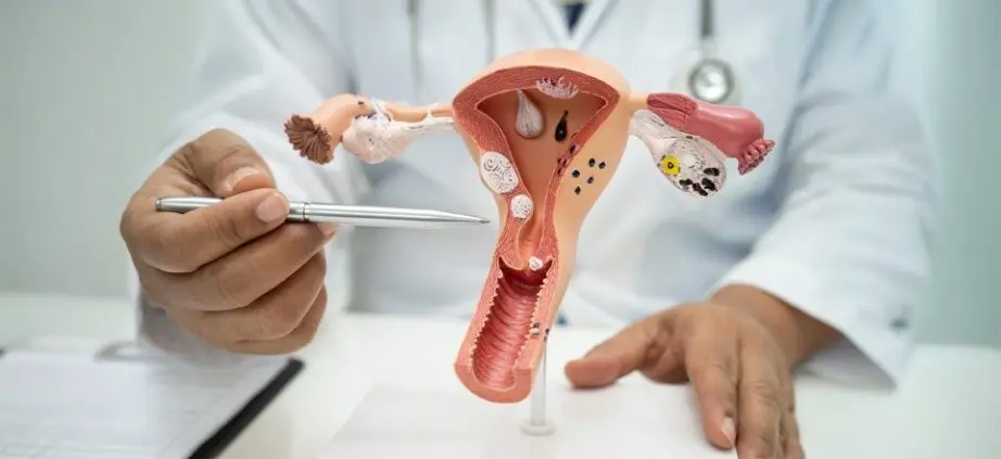 cervical-polyp